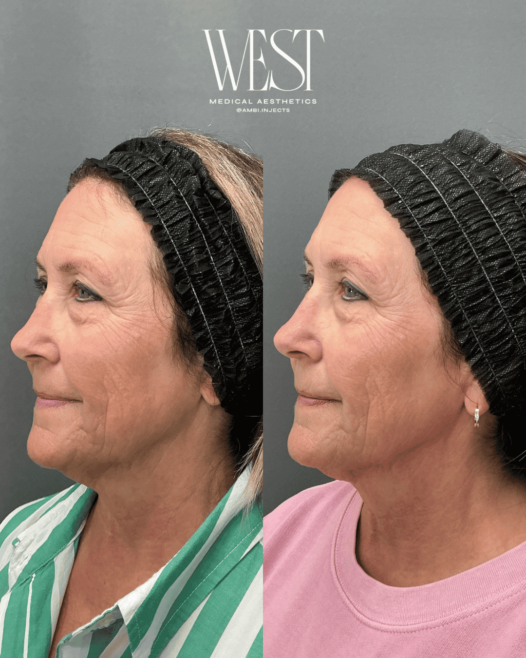 BBL Laser skin treatment in okc