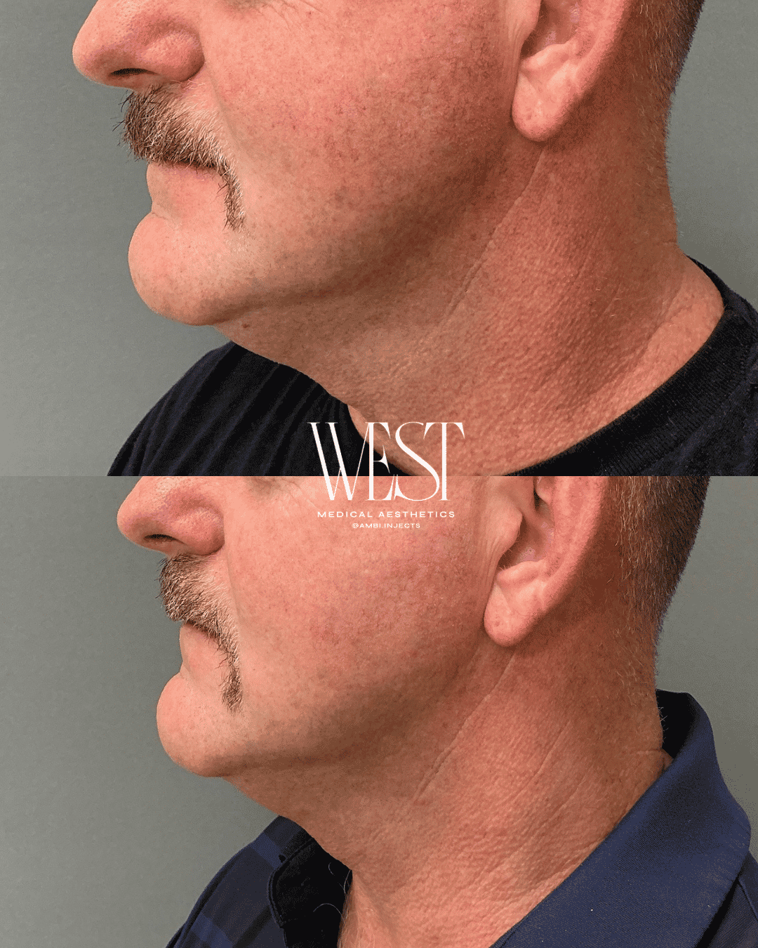 Mens skin laser treatment in OKC