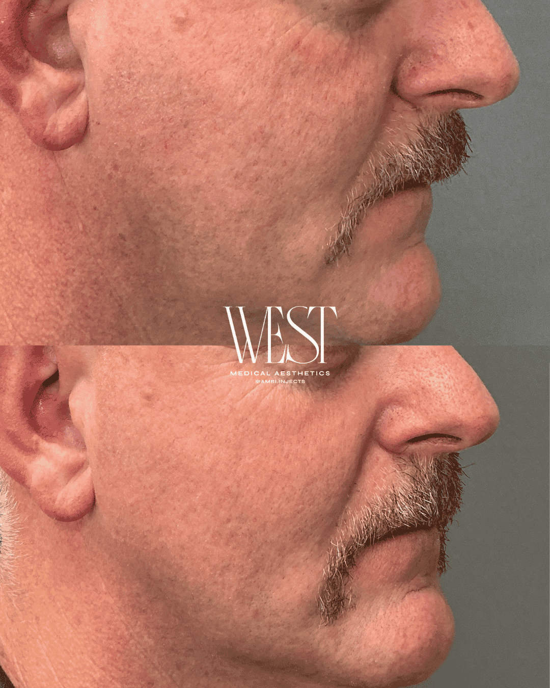 Mens skin laser treatment in OKC