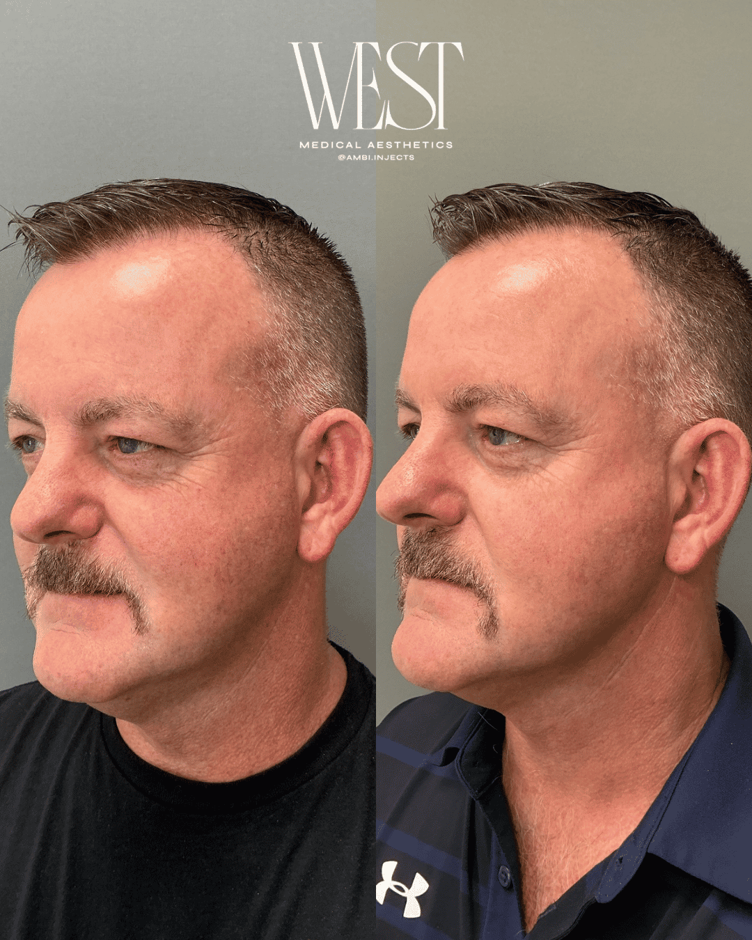 Mens skin laser treatment in OKC