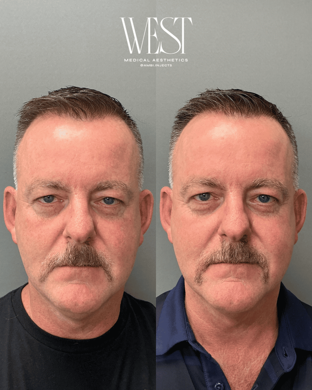 Mens skin laser treatment in OKC