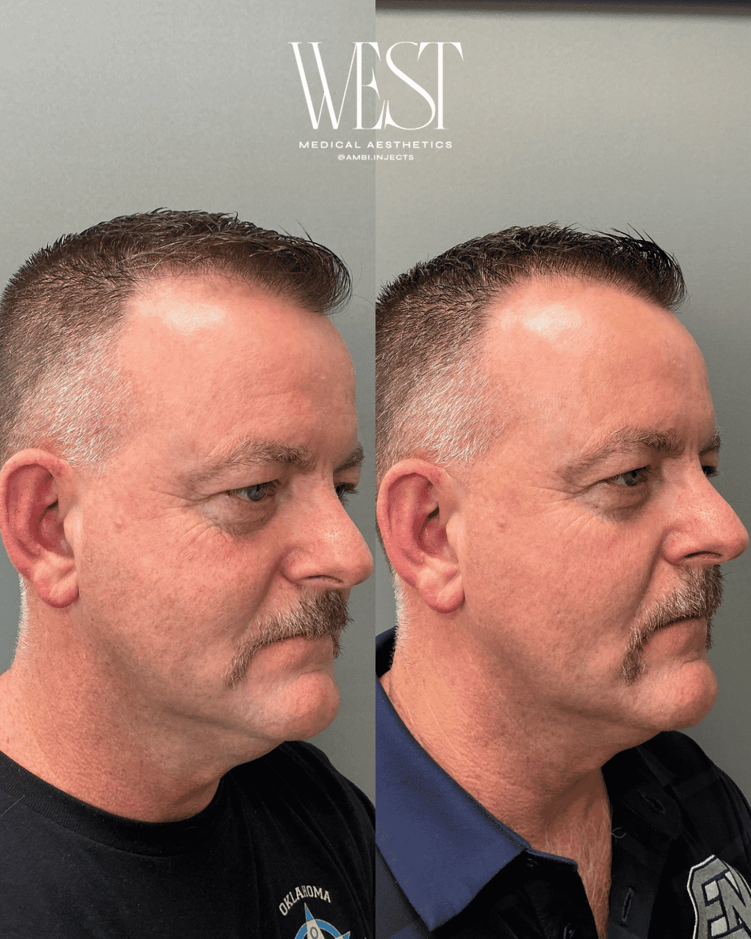 Mens skin laser treatment in OKC