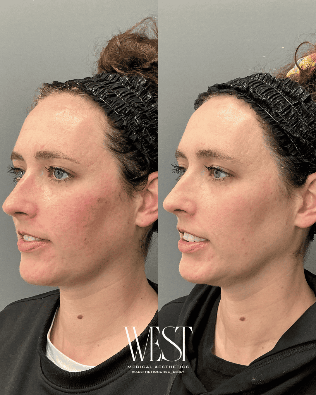 BBL Skin laser treatment in oklahoma city