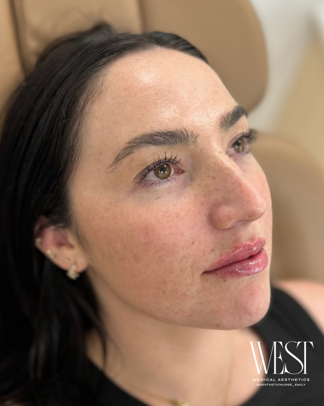 Lip Filler in OKC
