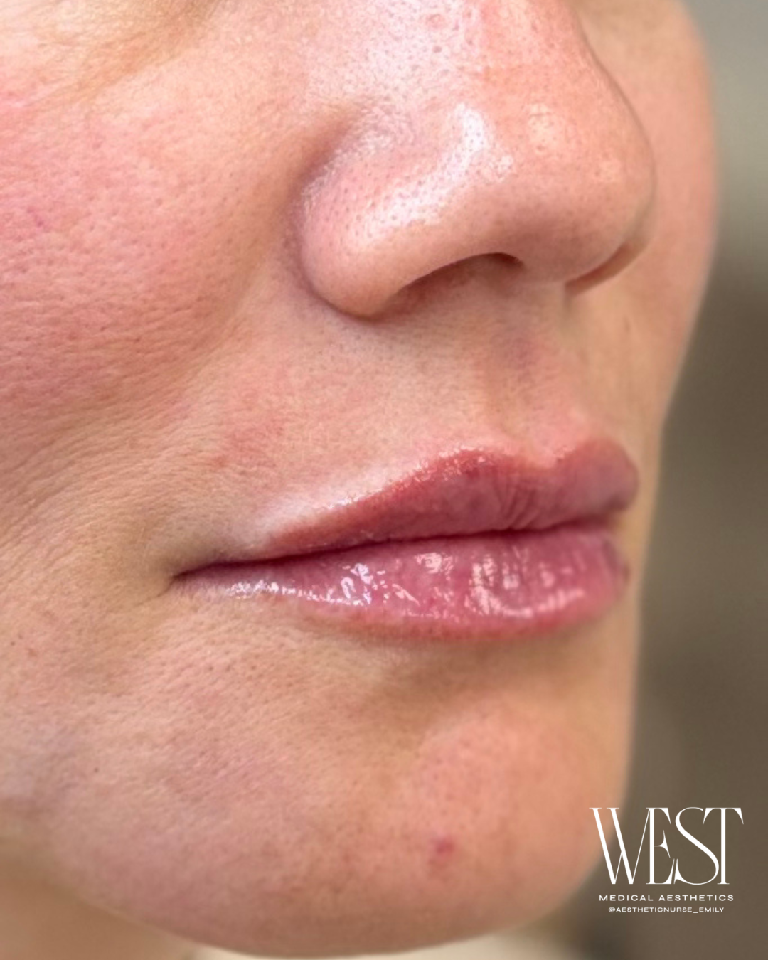 Lip Filler in OKC