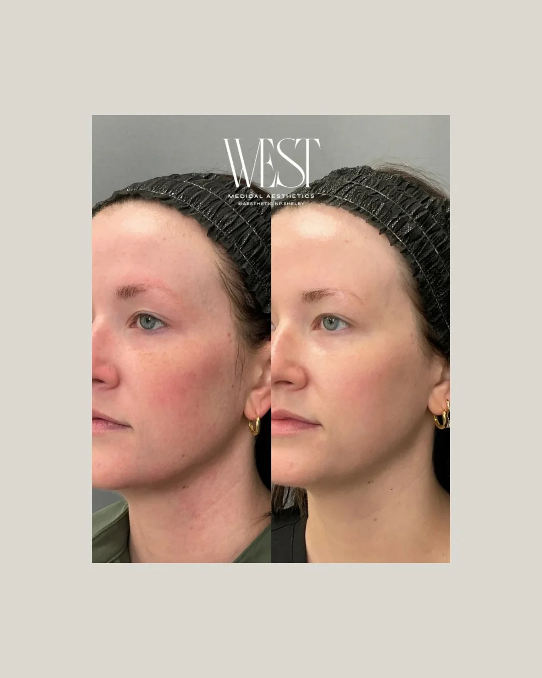 BBL + MOXI doing what they do best. ✨

This is Shelby&rsquo;s treatment, performed by a trainer during a recent training session. This powerful combination is designed to target sun damage, uneven tone, texture, and overall skin quality for a brighte