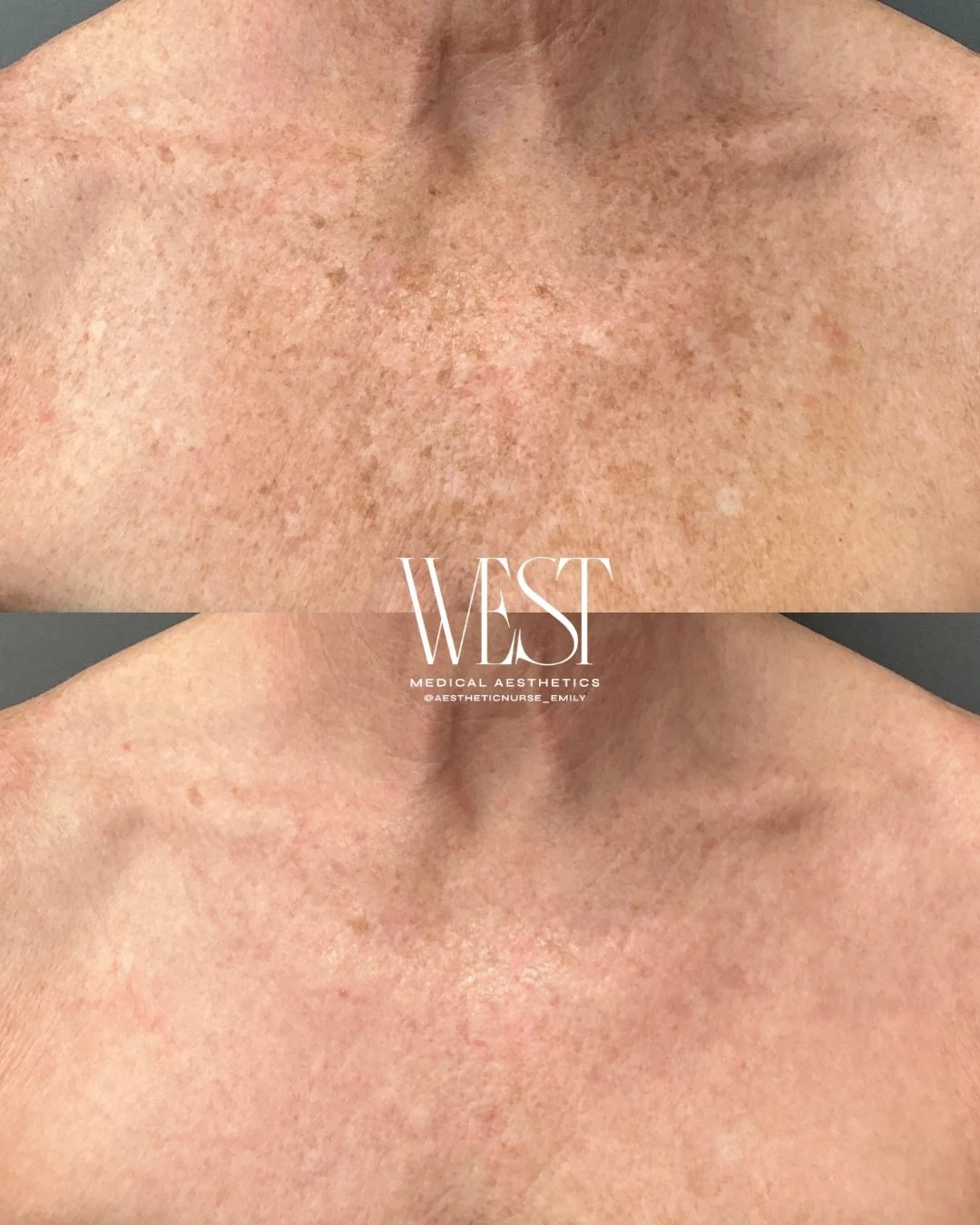 Laser season is officially here. ✨

These chest before + afters by Emily show what laser treatments can do for visible sun damage, discoloration, and uneven tone.

Because your skincare shouldn&rsquo;t stop at your face. 🤍

#okcmedspa #laserseason #