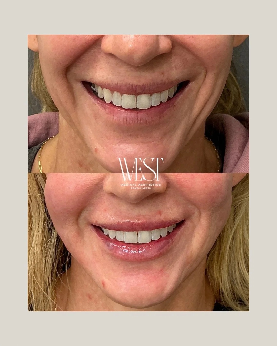 Some before + after lips by Amberlie 💋

Soft, balanced, and still completely you. A little lip filler can go a long way when it&rsquo;s tailored to your features.

#westmedspa #lipfiller #okcmedspa #okcaesthetics #okcinjector