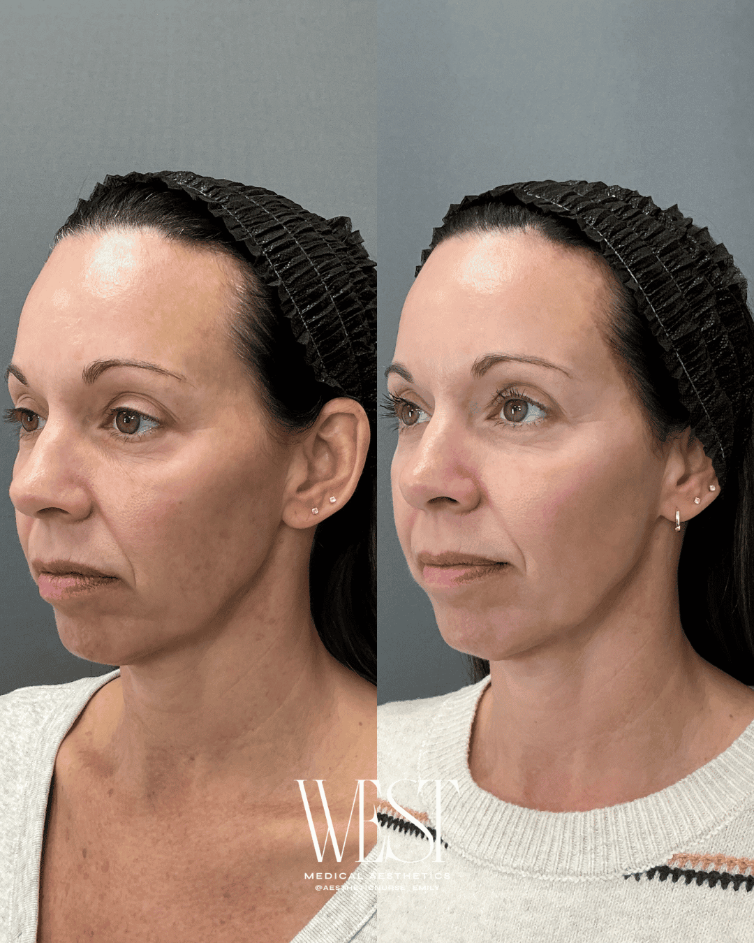 BBL Skin laser treatment in oklahoma city