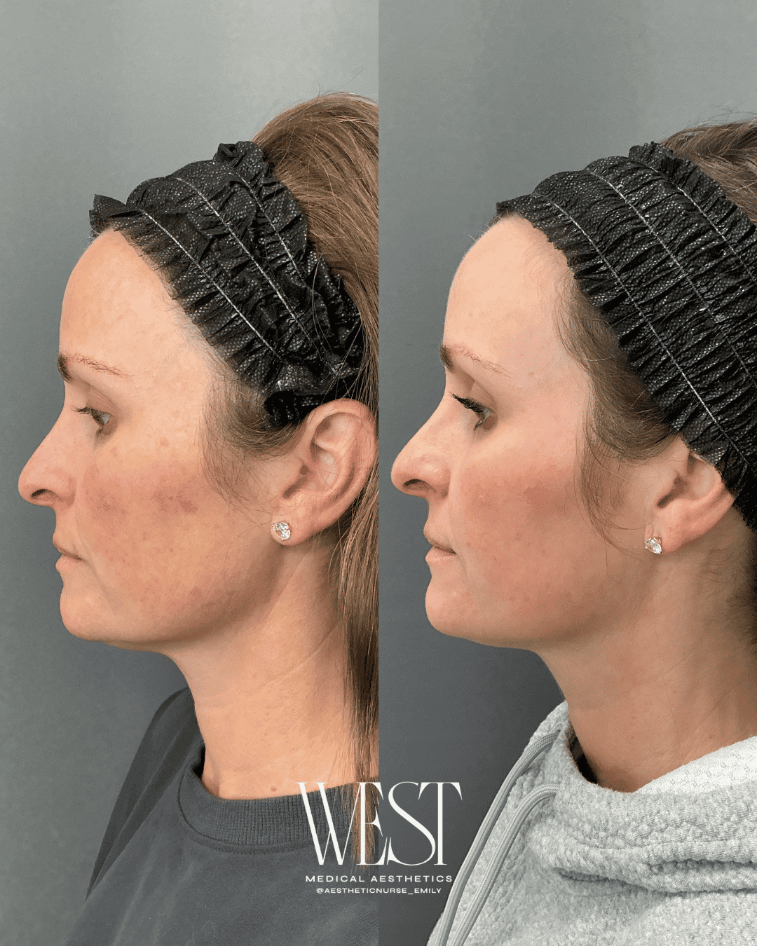 Moxi laser skin treatments in OKC