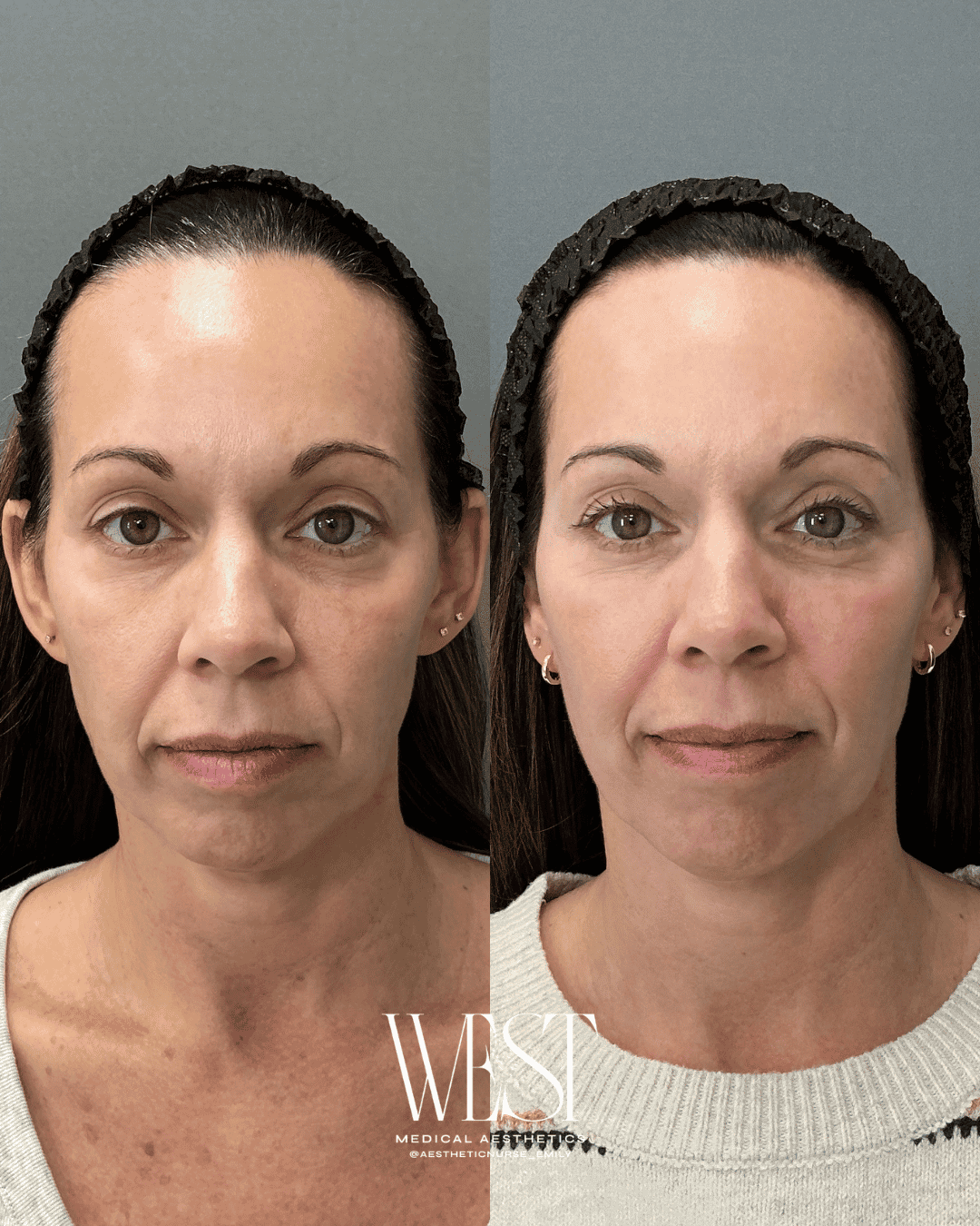 BBL Skin laser treatment in oklahoma city