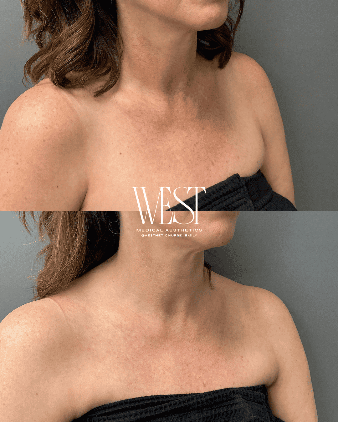 chest laser skin treatment okc