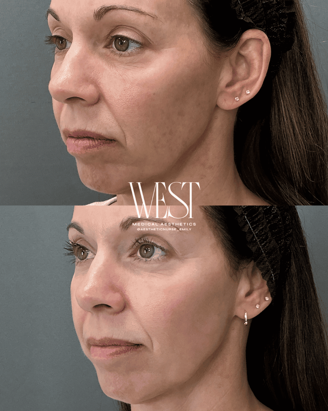 BBL Skin laser treatment in oklahoma city