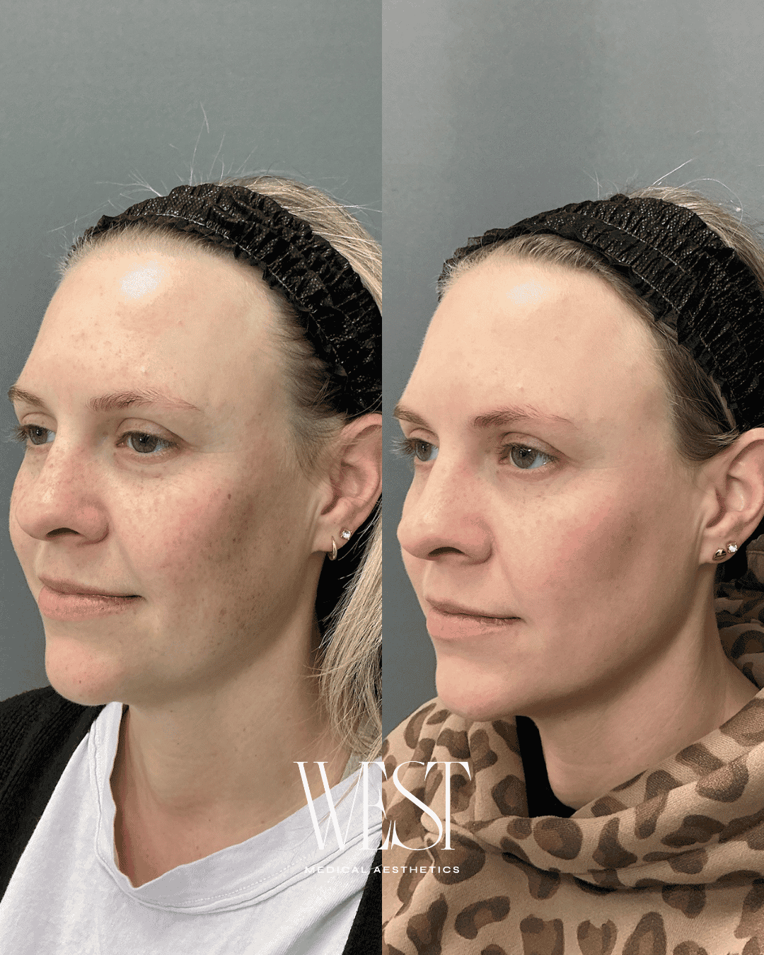 Acne scar treatment in okc