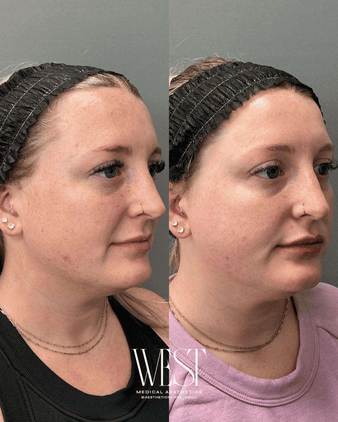 Laser skin treatment in oklahoma city