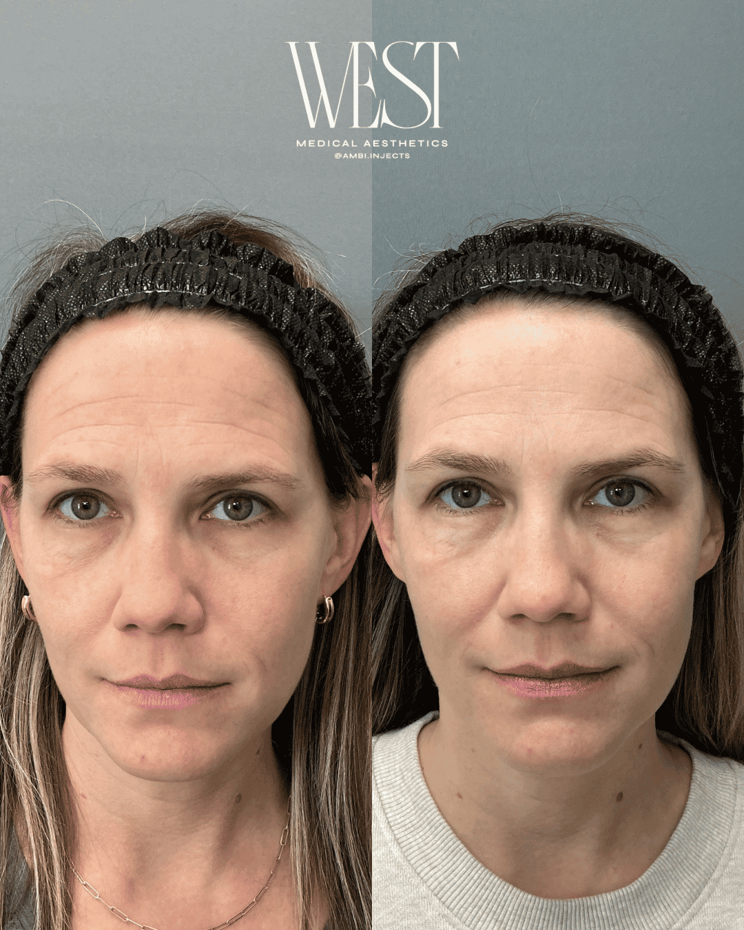 BBL Light and Laser Skin Treatment in OKC