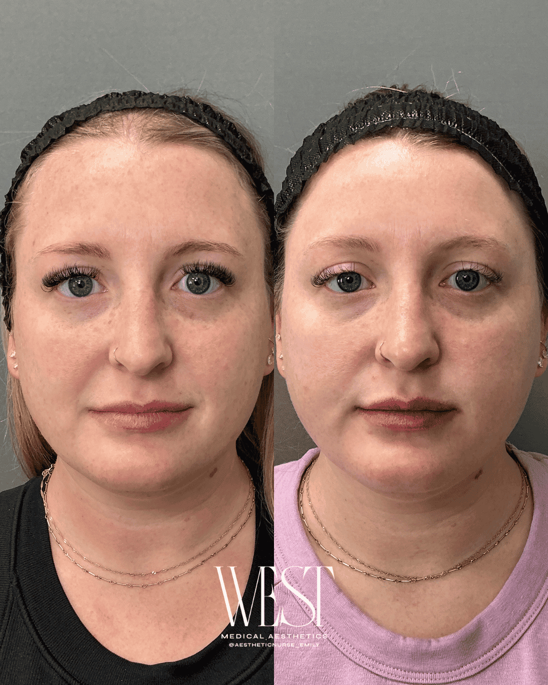 Laser skin treatment in oklahoma city