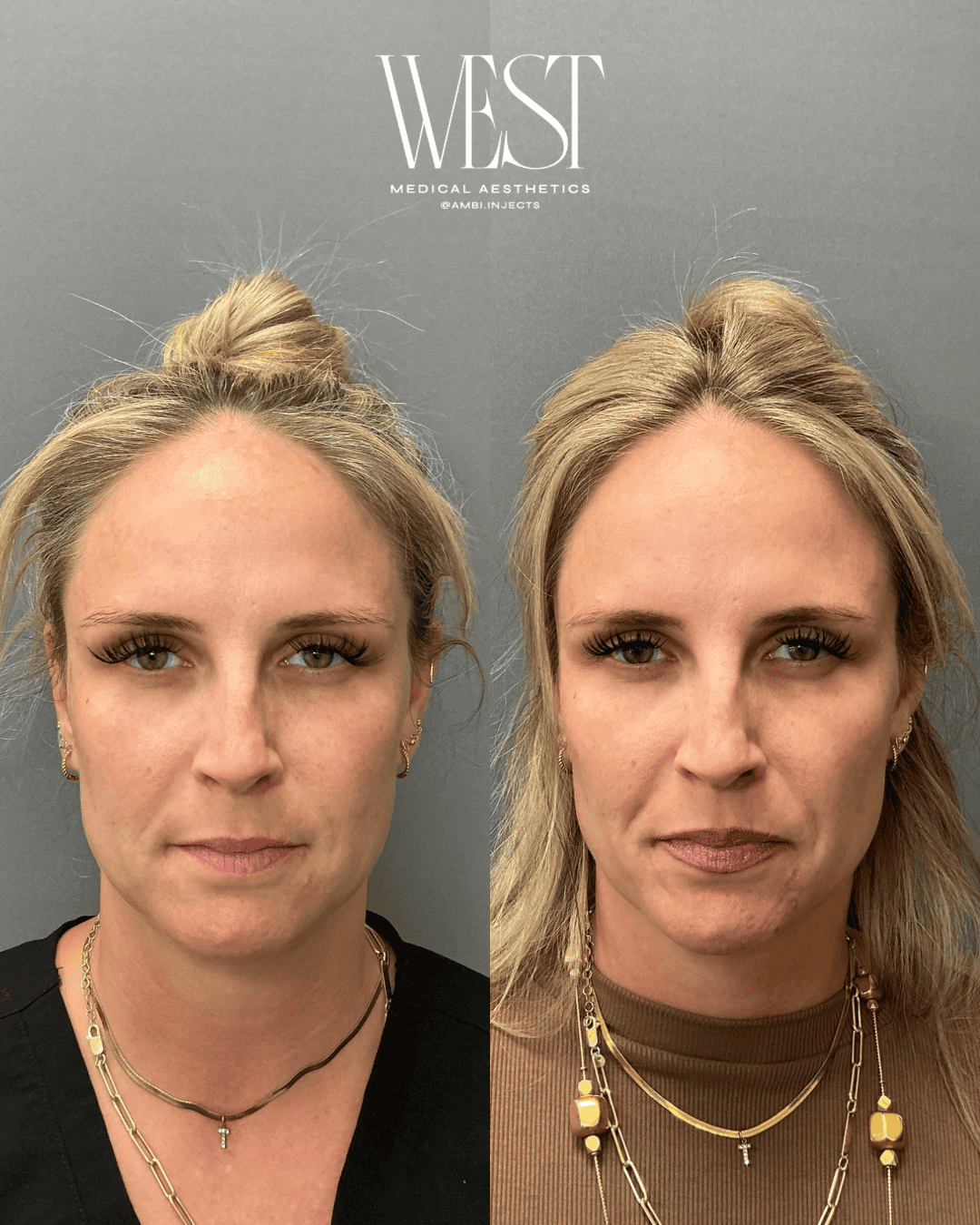 Daxxify Injectable in OKC