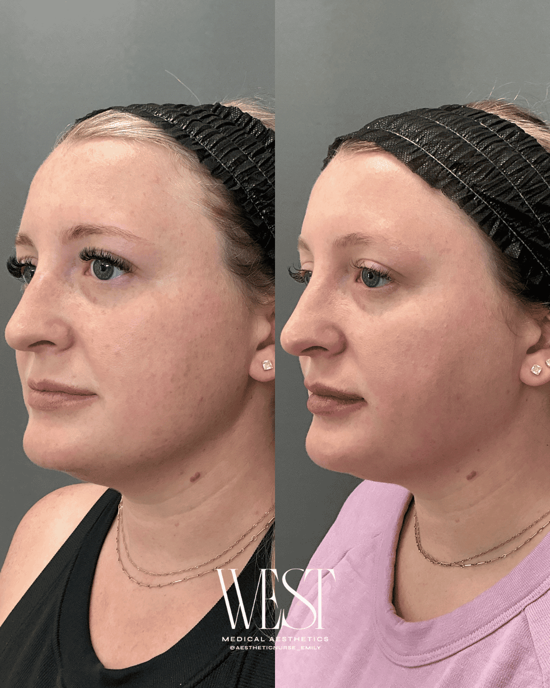 Laser skin treatment in oklahoma city