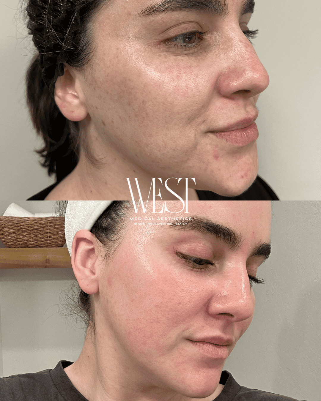 Laser skin treatment in okc