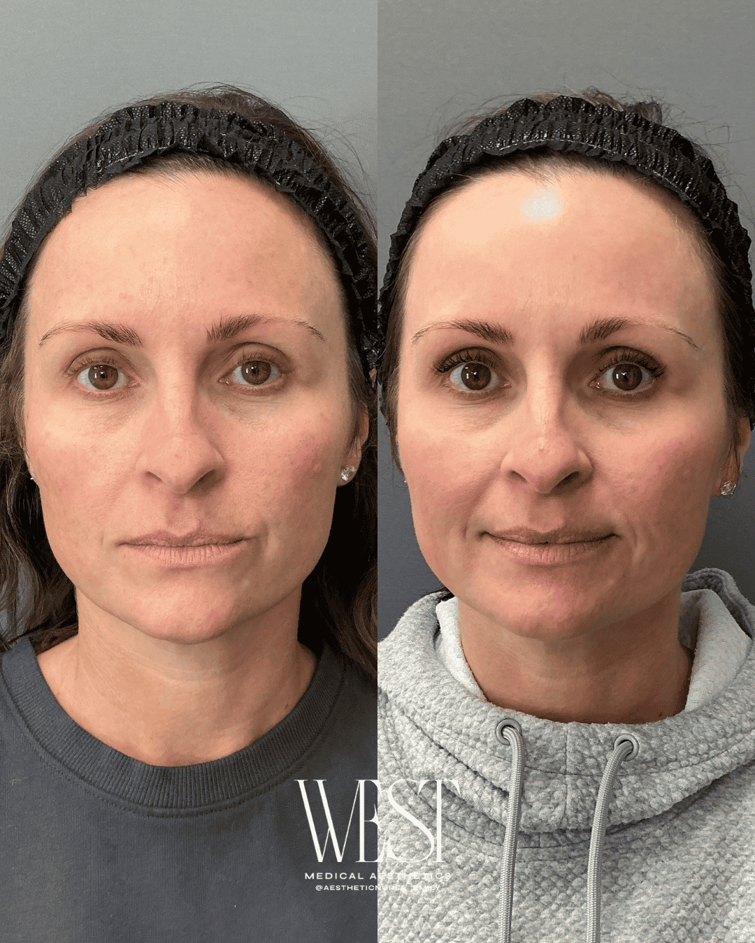Moxi laser skin treatments in OKC