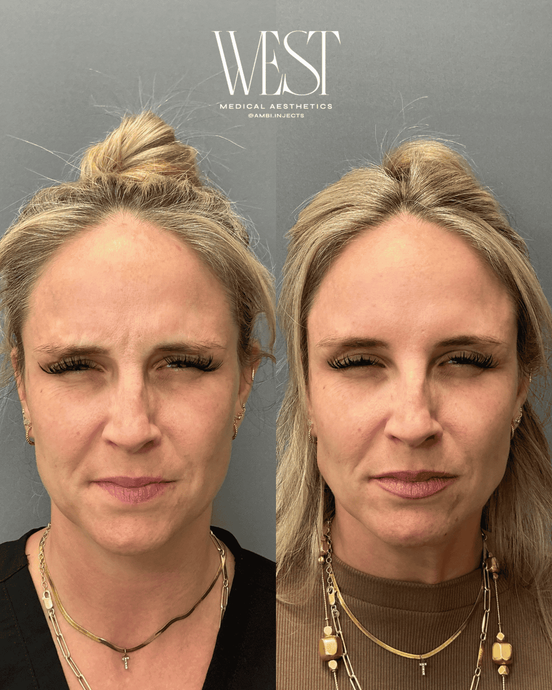 Daxxify Injectable in OKC