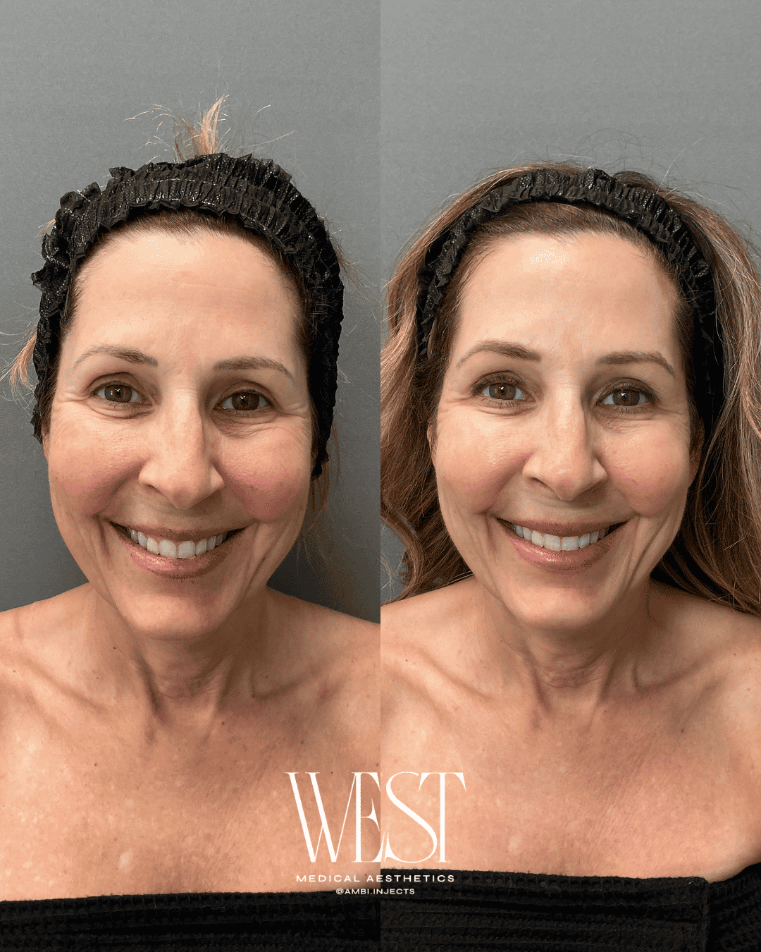 Moxi Laser skin treatment in okc