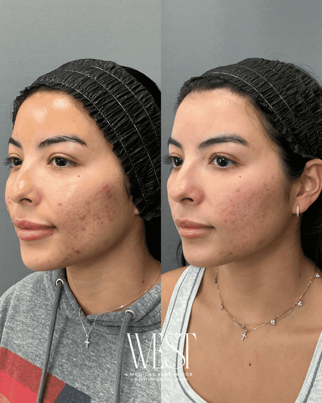 Acne treatment in okc