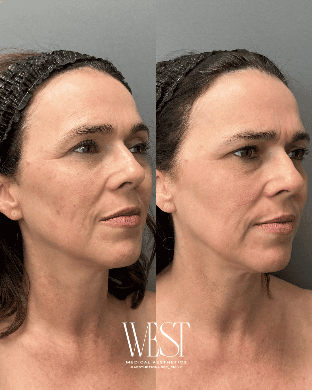 BBL Skin laser treatment in oklahoma city