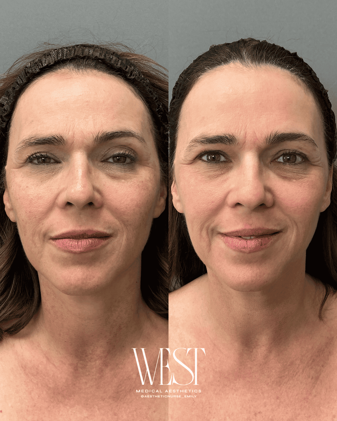BBL Skin laser treatment in oklahoma city