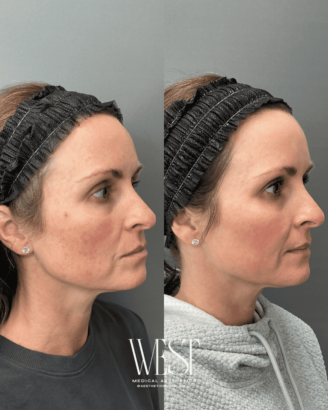 Moxi laser skin treatments in OKC