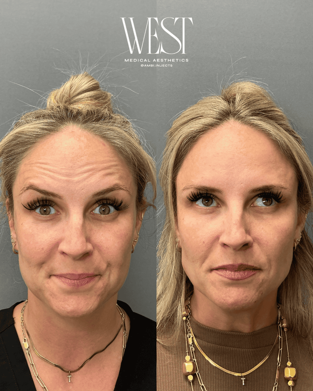 Daxxify Injectable in OKC