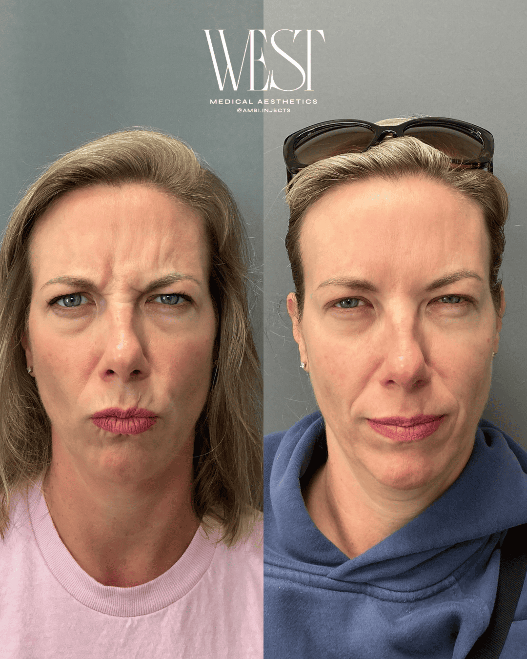 Daxxify Injectable in OKC