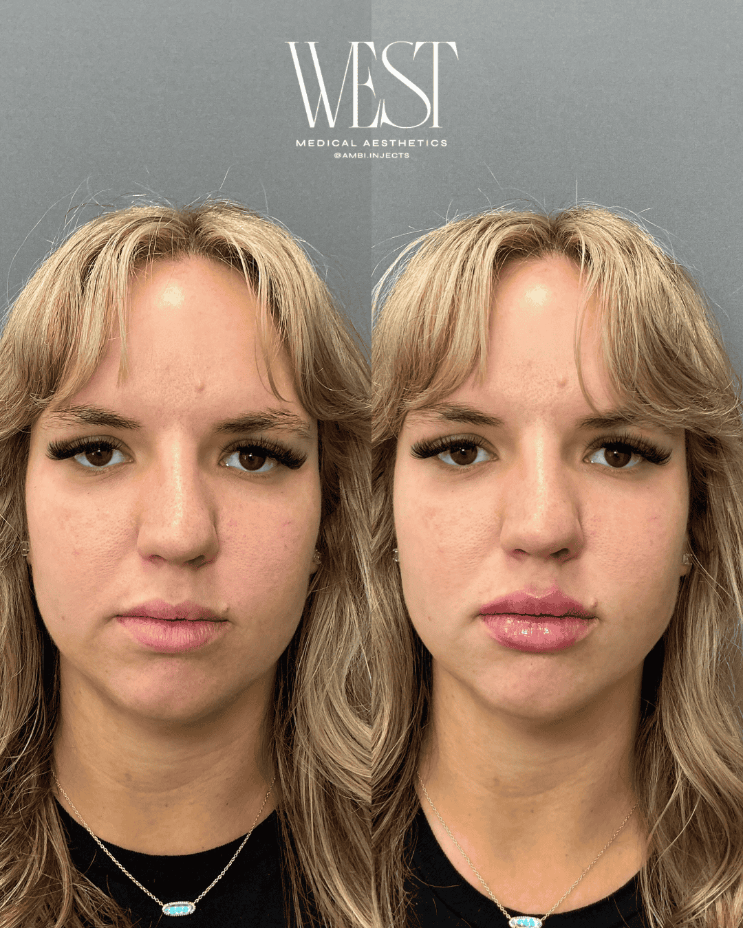 best lip filler in oklahoma city