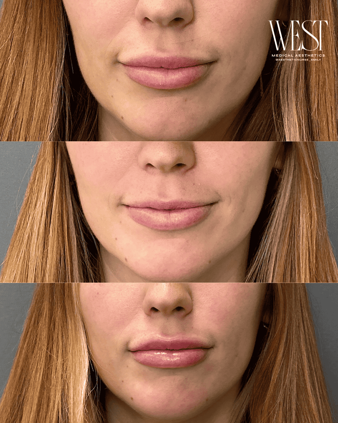 best lip filler in oklahoma city