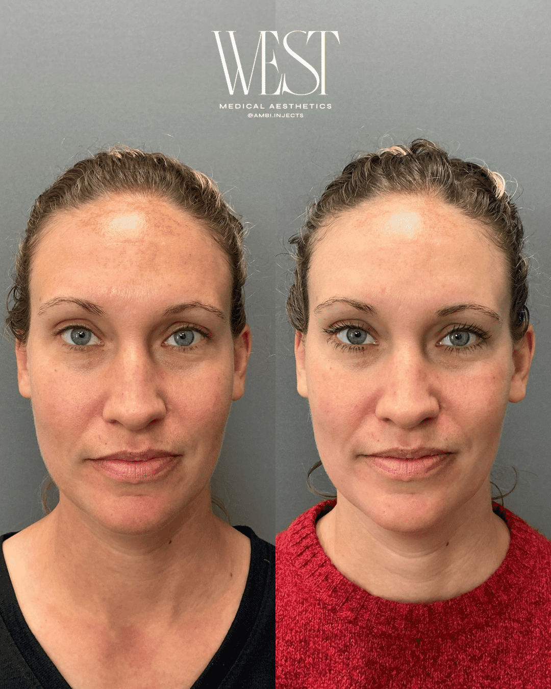 Moxi Laser skin treatment in oklahoma city