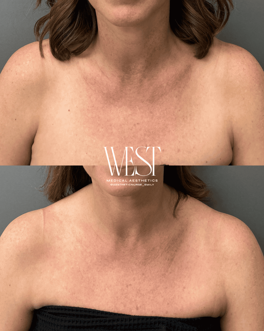 chest laser skin treatment okc