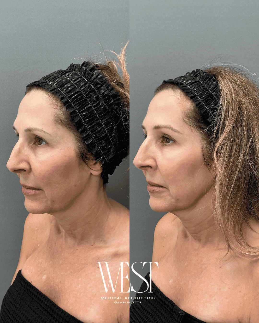 Laser skin treatment in okc