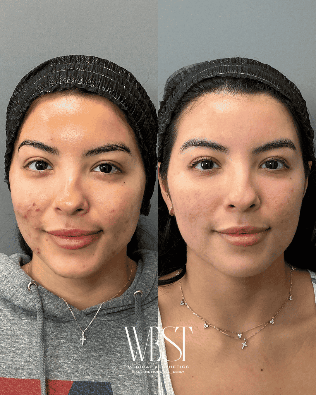 Acne treatment in okc