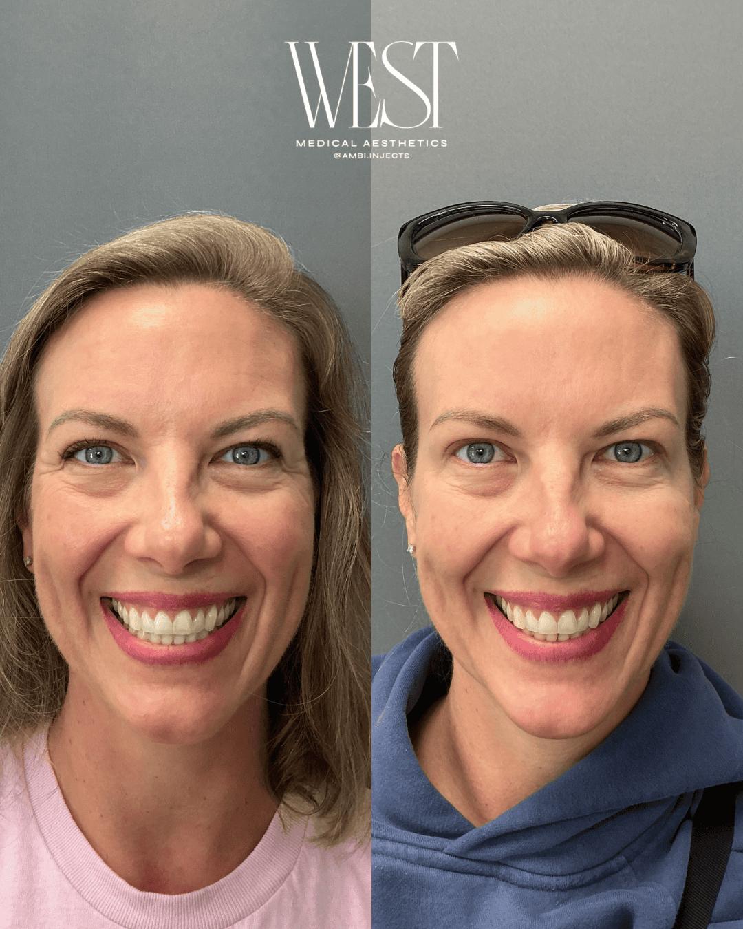 Daxxify Injectable in OKC