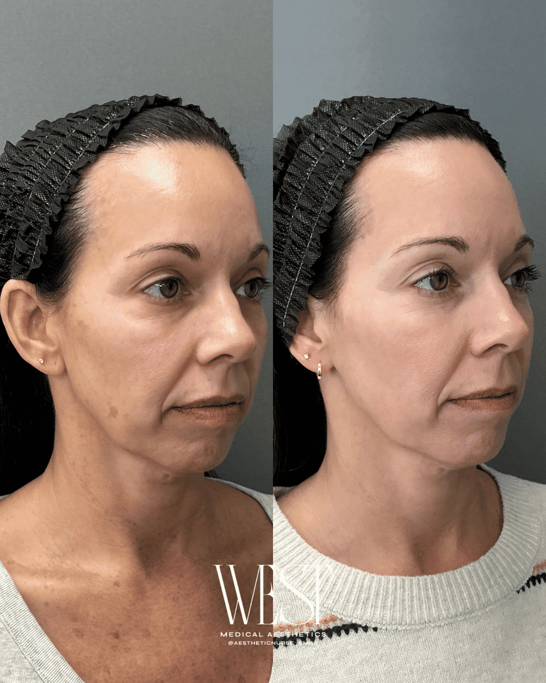 BBL Skin laser treatment in oklahoma city