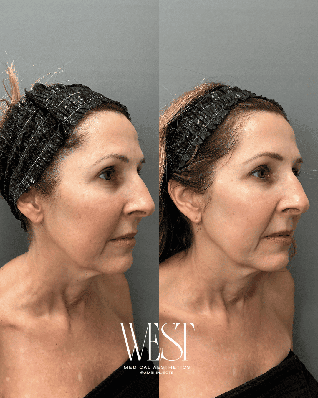 Laser moxi skin treatment in okc