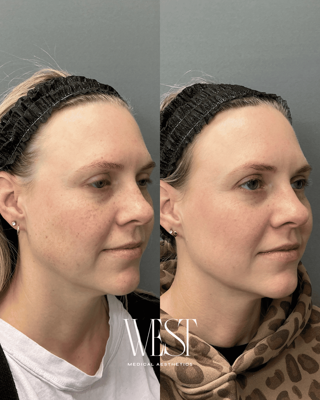 Laser skin treatment before and after in OKC