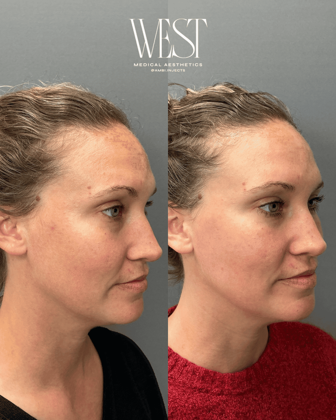 Moxi Laser skin treatment in oklahoma city
