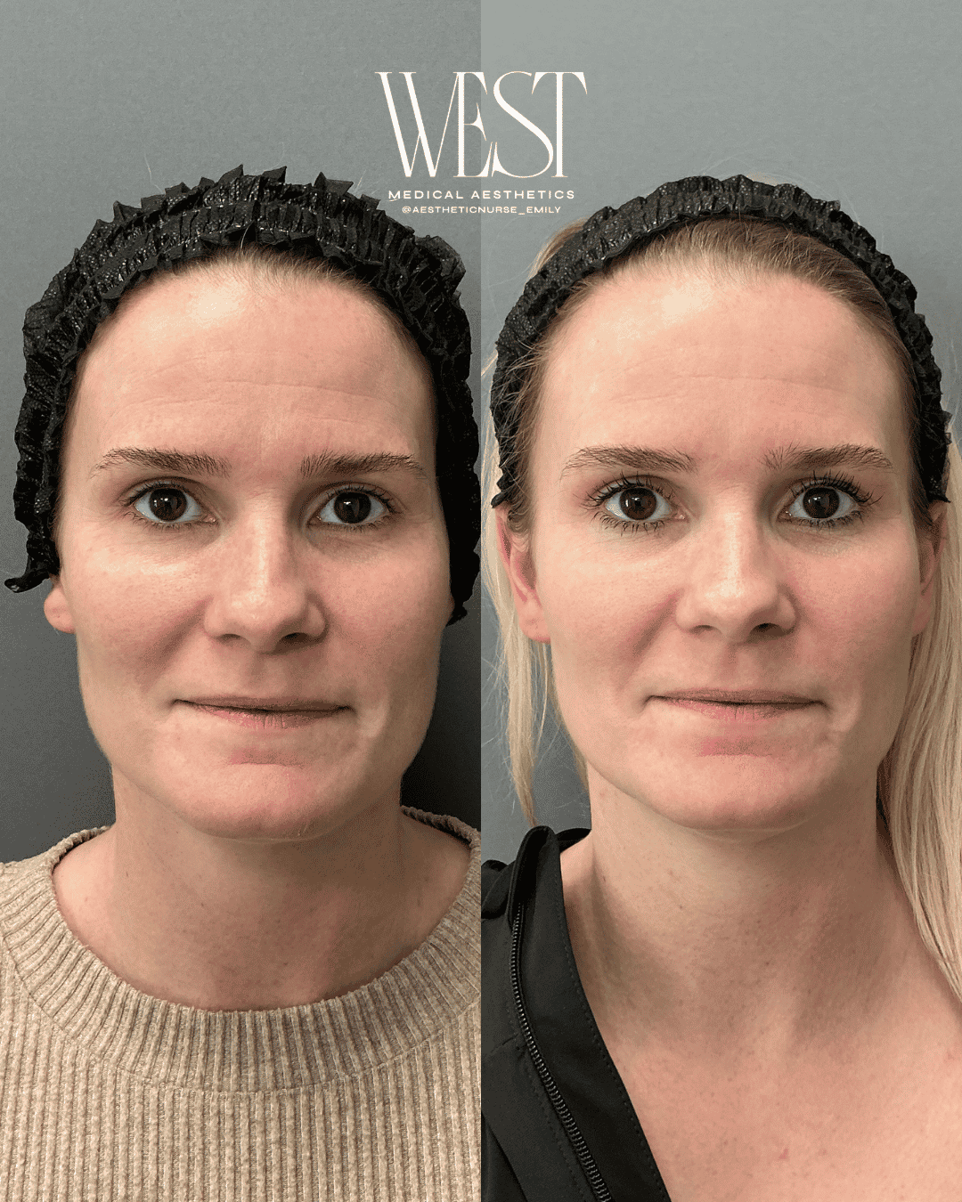 Moxi laser skin treatments in OKC