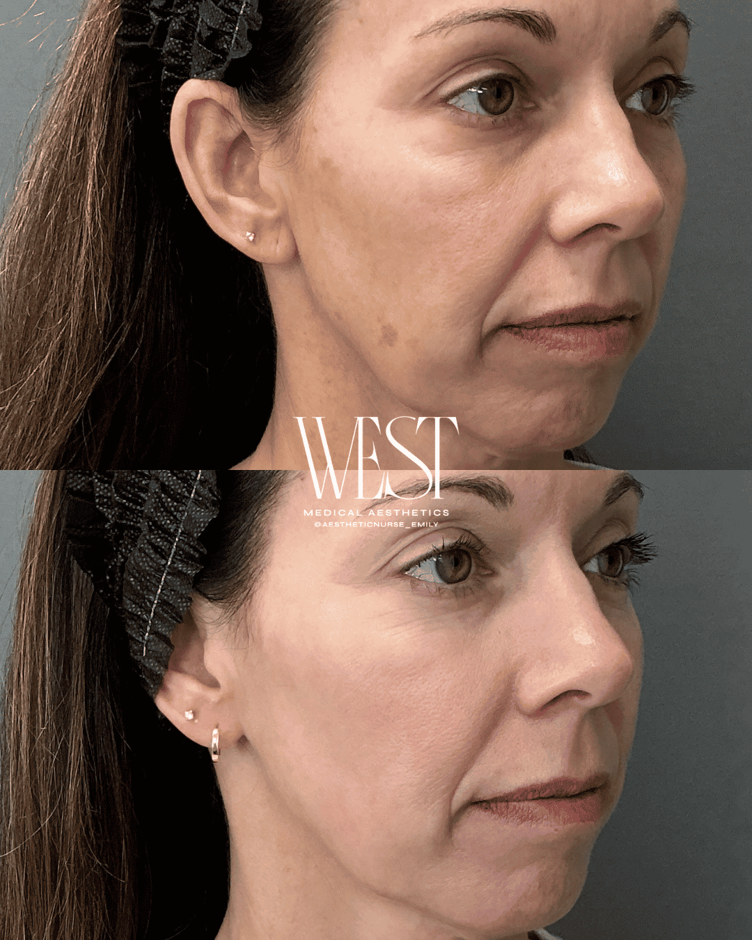 BBL Skin laser treatment in oklahoma city