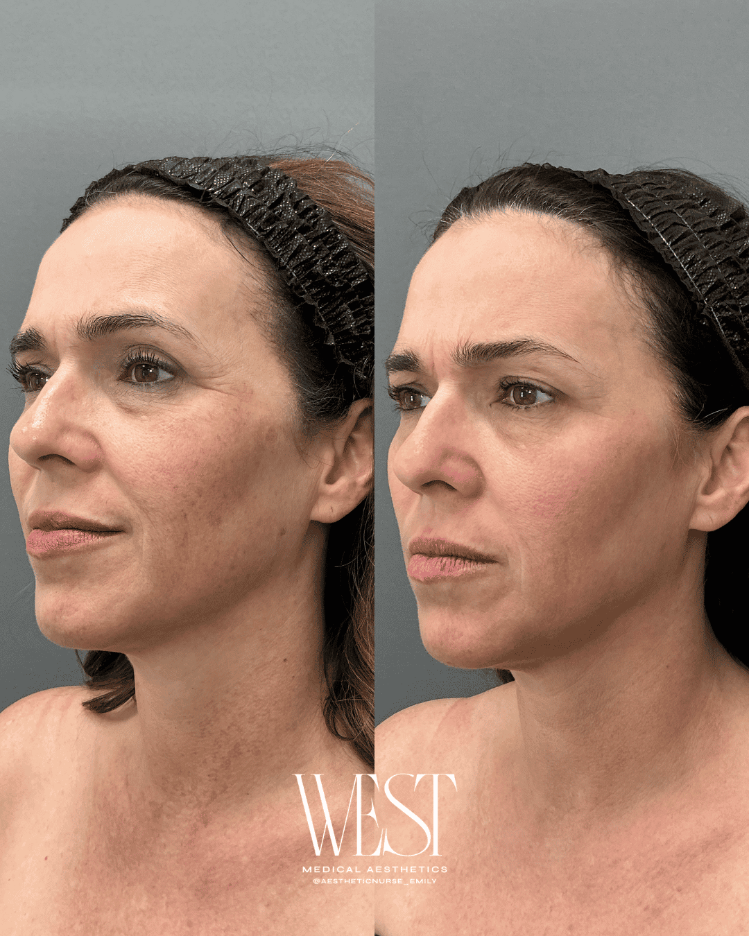 BBL Skin laser treatment in oklahoma city