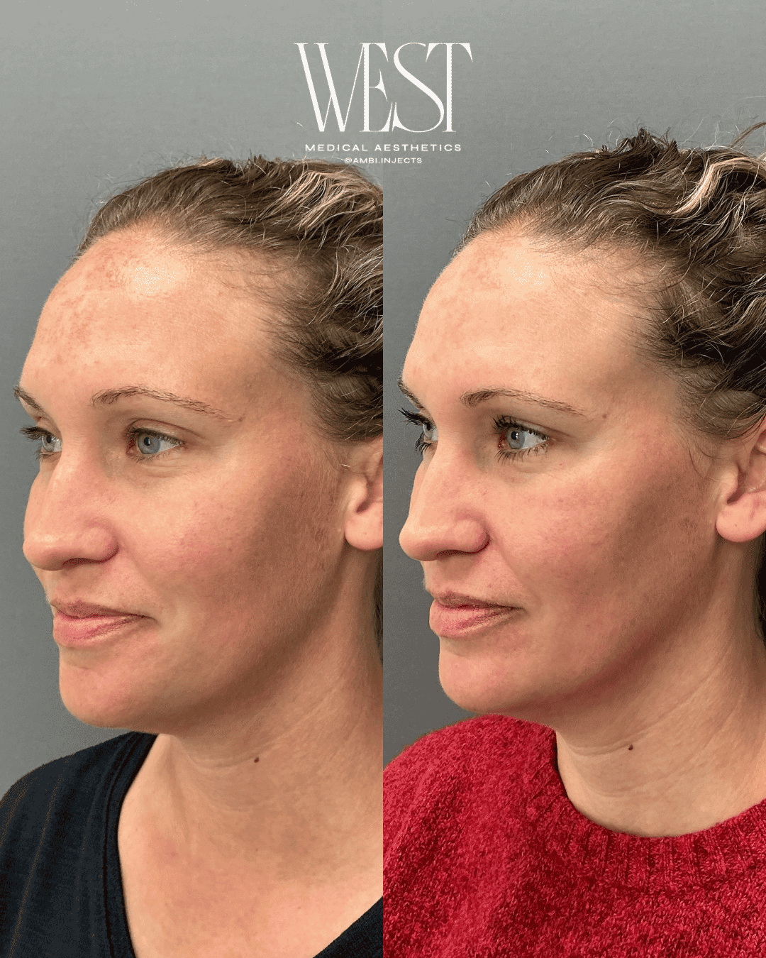 Moxi Laser skin treatment in oklahoma city