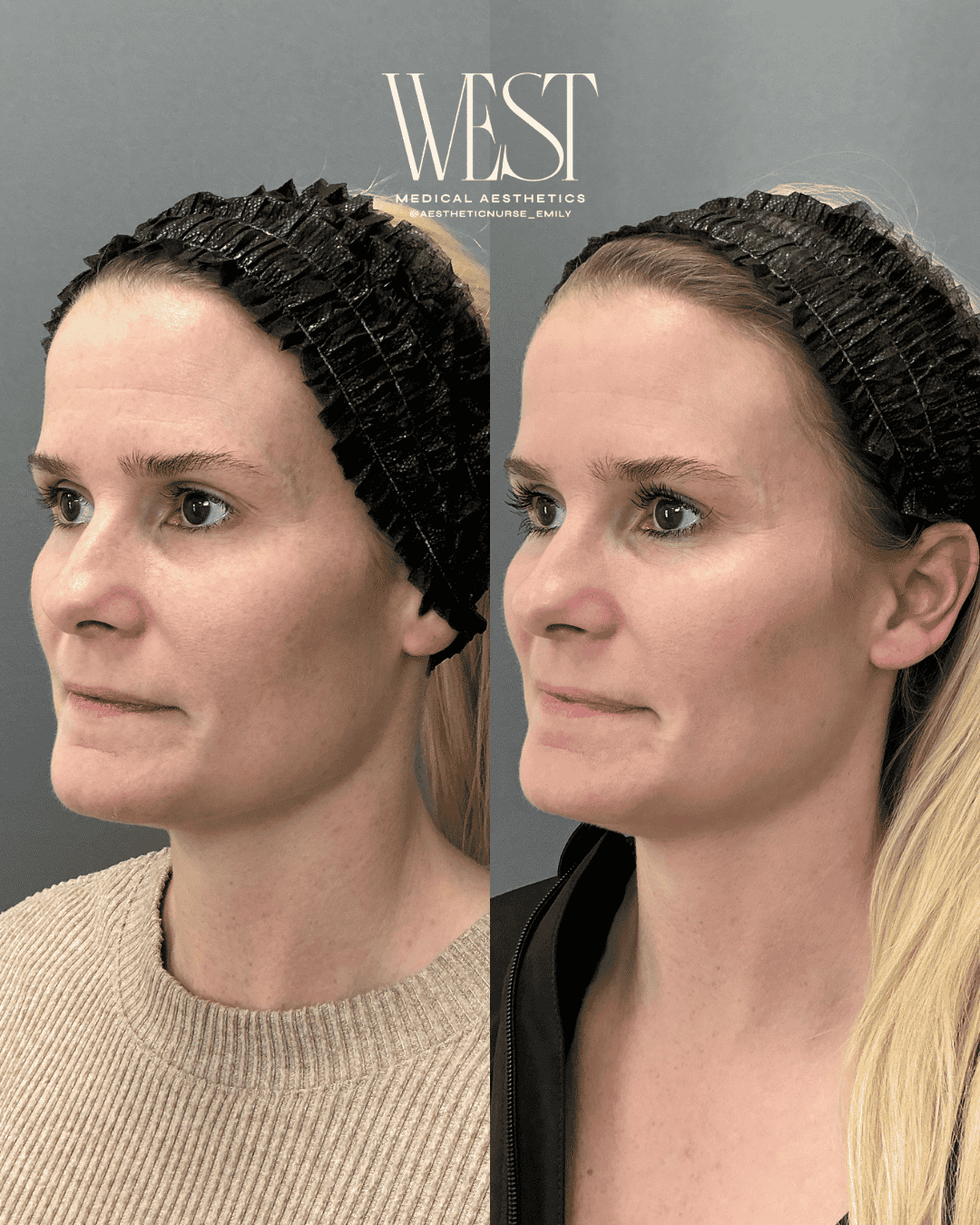 Moxi laser skin treatments in OKC