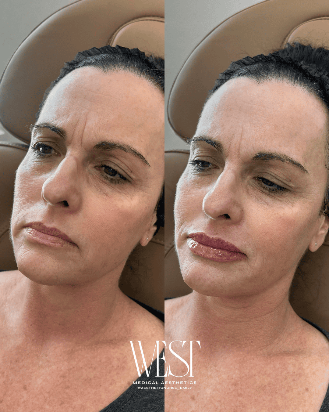 lip filler in okc